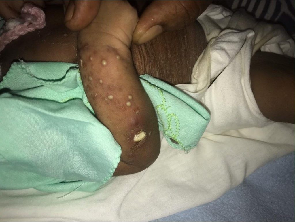 Infección cutánea - Les Cayes, Haití
